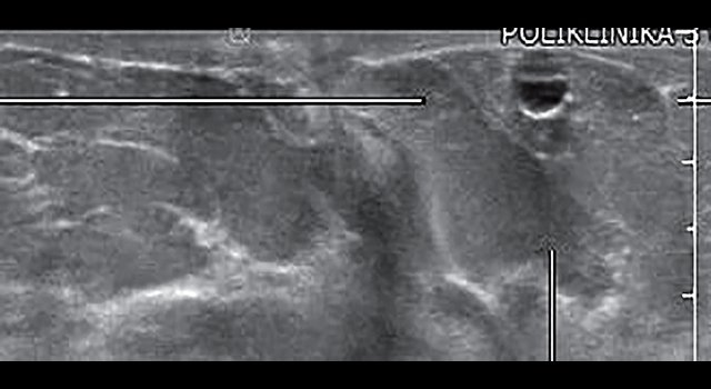 УЗ-картина молочной железы через 2,5 года после липотрансфера - объемное сканирование, сагиттальный срез