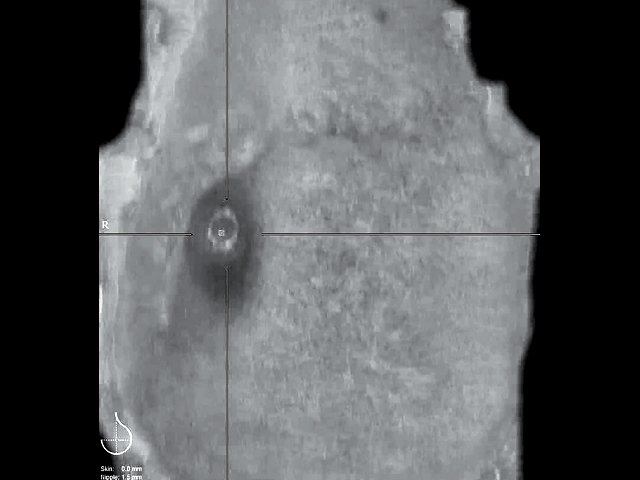 УЗ-картина молочной железы после радикальной резекции - коронарный срез на глубине 0 мм