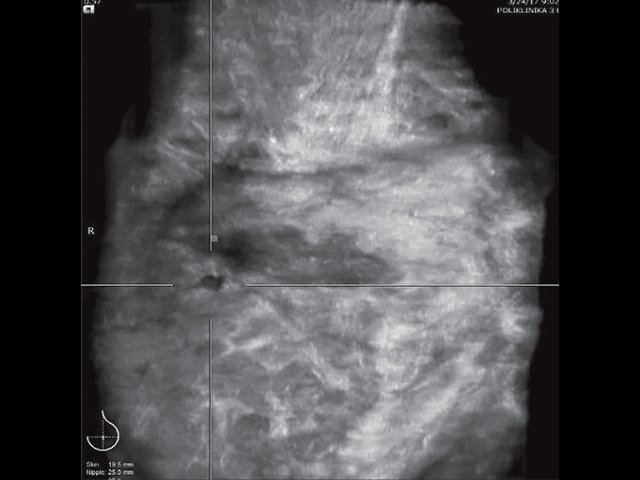 УЗ-картина молочной железы после радикальной резекции - коронарный срез на глубине 19,5 мм