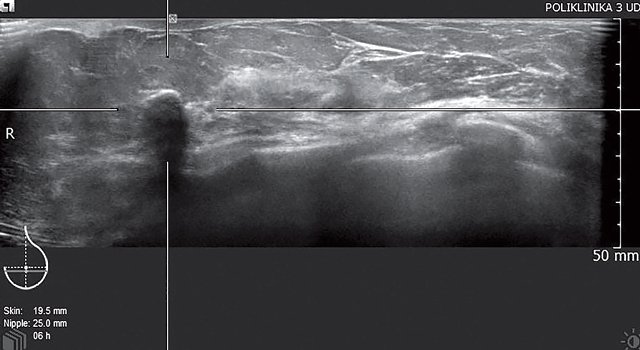 УЗ-картина молочной железы после радикальной резекции - горизонтальны срез