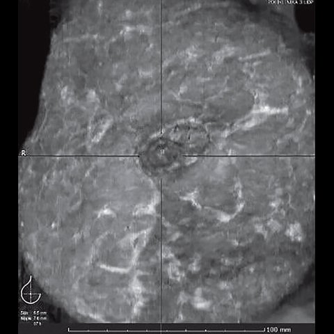 УЗ-картина молочной железы через 3 года после радикальной резекции с одновременной пластикой соска - нет отека клетчатки