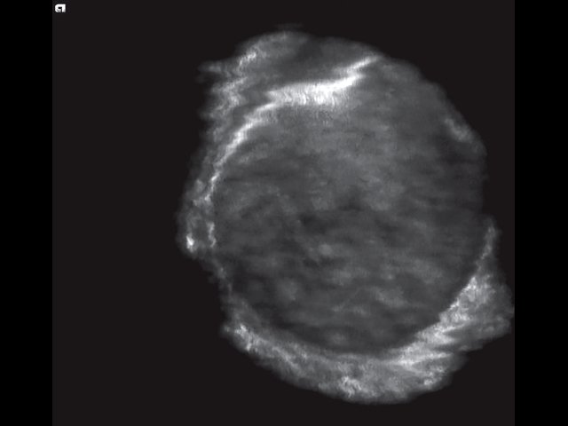 УЗ-картина двухслойного гладкокасульного импланта молочной железы - коронарный срез