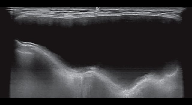 УЗ-картина двухслойного гладкокасульного импланта молочной железы - сагиттальный срез