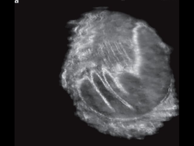 УЗ-картина правой молочной железы через 4 года после эндопротезирования - передняя проекция, коронарный срез