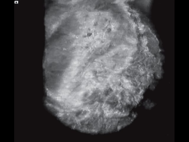 УЗ-картина левой молочной железы через 4 года после эндопротезирования - латеральная проекция, коронарный срез