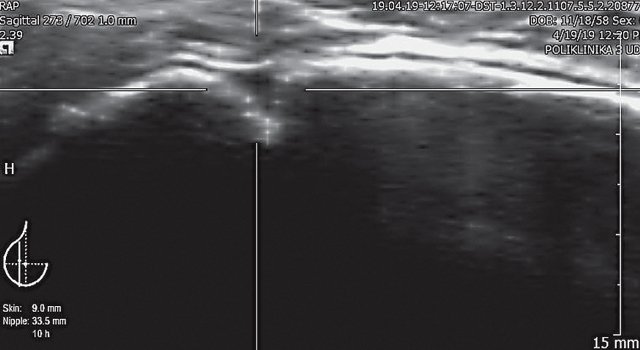 УЗ-картина текстурированного импланта молочной железы - капсулярный фиброз