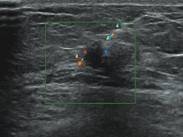 Эхограмма - локальное усиление кровотока в зоне очагового поражения молочной железы, режим ЦДК