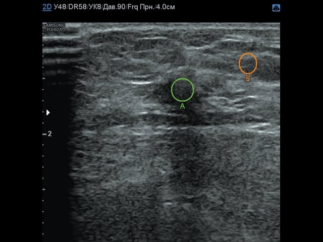 Эхограмма опухоли молочной железы - зона интереса, B-режим
