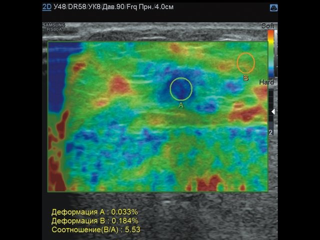 Эластограмма опухоли молочной железы - картограмма повышенной жесткости