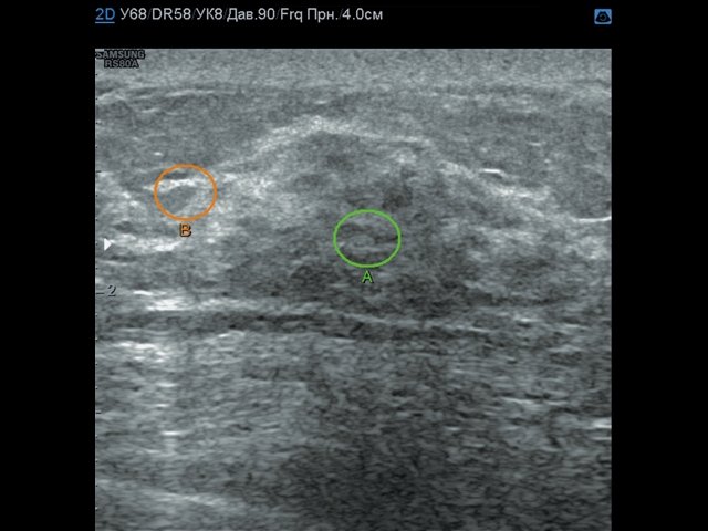 Эхограмма диабетического фиброза молочной железы - зона интереса, B-режим