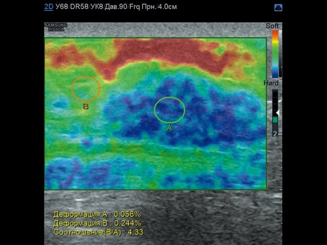 Эластограмма диабетического фиброза молочной железы - картограмма повышенной жесткости