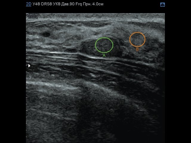 Эхограмма фиброаденомы молочной железы - зона интереса, B-режим