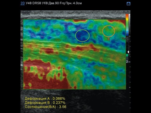 Эластограмма фиброаденомы молочной железы - картограмма повышенной жесткости
