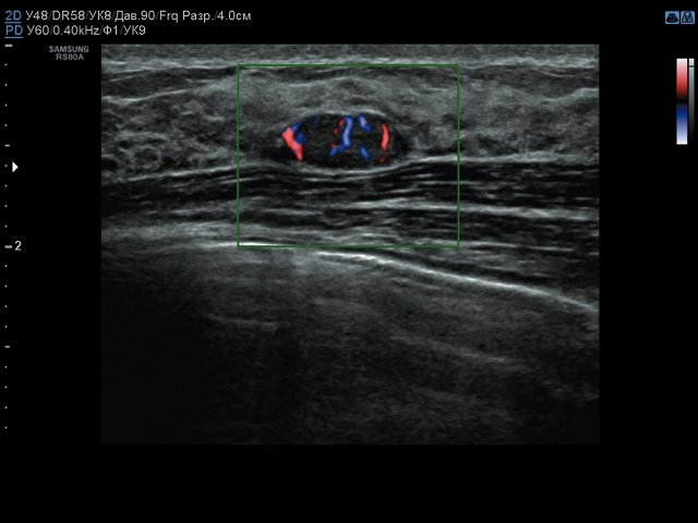 Эхограмма фиброаденомы молочной железы - внутриузловой кровоток, режим ЦДК