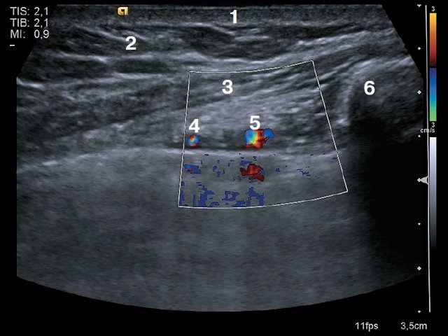 УЗИ окологрудинной области - поперечное сканирование: 1 – кожа, 2 – подкожно-жировая клетчатка, 3 – мышца (m.pectoralis major), 4 – внутренняя грудная вена, 5 – внутренняя грудная артерия, 6 – край грудины
