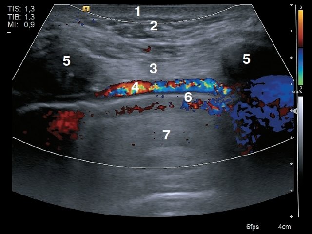УЗИ окологрудинной области - продольное сканирование: 1 – кожа, 2 – подкожно-жировая клетчатка, 3 – мышца (пучки межреберных мышц), 4 – внутренняя грудная артерия, 5 – ребра, 6 – плевра, 7 – легкое