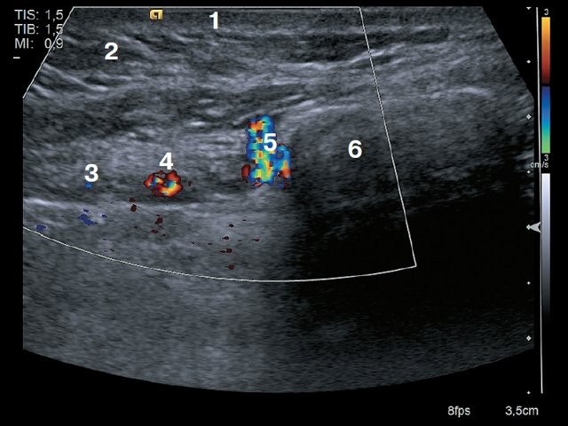 УЗИ окологрудинной области - поперечное сканирование: 1 – кожа, 2 – подкожно-жировая клетчатка, 3 – внутренняя грудная вена, 4 – внутренняя грудная артерия, 5 – прободающая ветвь внутренней грудной артерии, 6 – грудина, 7 – легкое