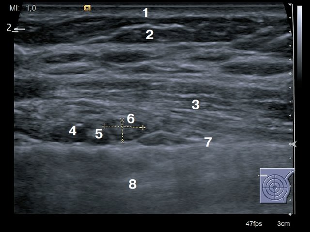 УЗИ окологрудинной области - поперечное сканирование: 1 – кожа, 2 – подкожно-жировая клетчатка, 3 – мышца (m.pectoralis major), 4 – внутренняя грудная артерия, 5 – внутренняя грудная вена, 6 – лимфатический узел сохранной структуры, 7 – плевра, 8 – легкое