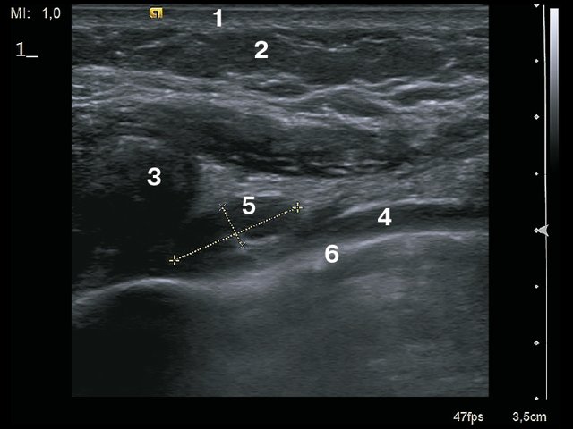 УЗИ окологрудинной области - продольное сканирование: 1 – кожа, 2 – подкожно-жировая клетчатка, 3 – ребро, 4 – внутренняя грудная артерия, 5 – лимфатический узел сохранной структуры, 6 – плевра