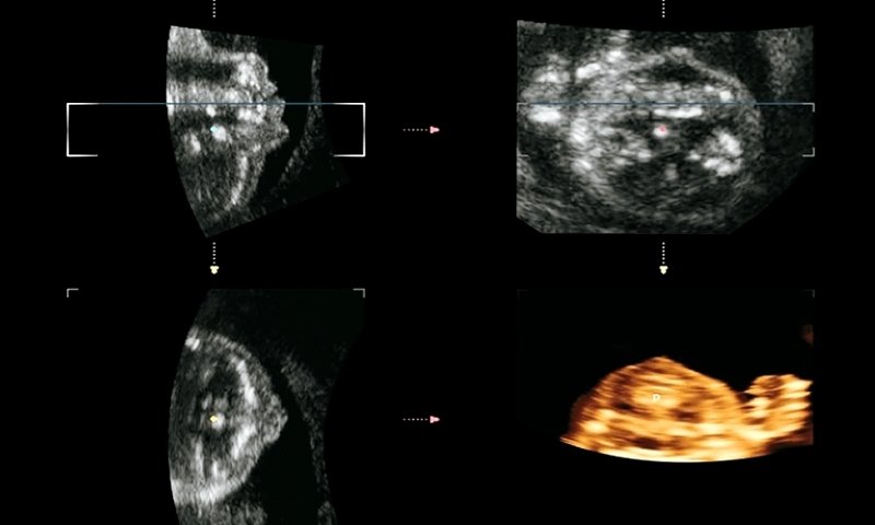 Эхограмма - реконструкция нёба плода методом MPR
