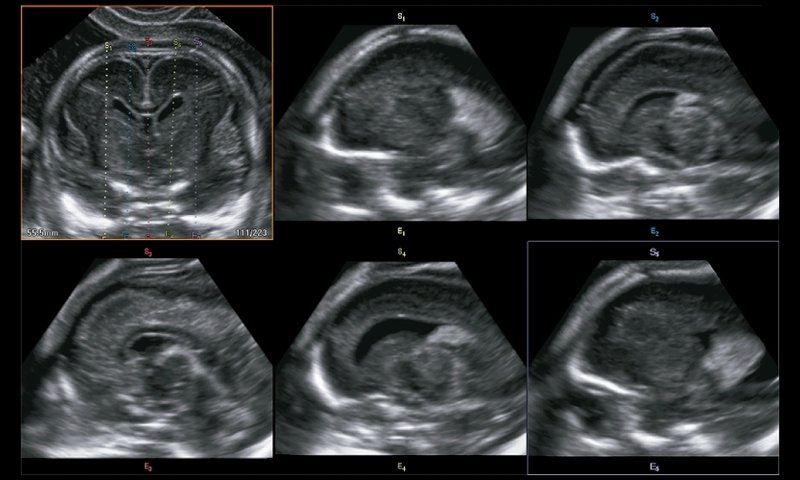 Эхограмма - множественные изображения мозга плода в сагиттальной плоскости, полученные с помощью Multi OV из
                                        фронтальной плоскости.