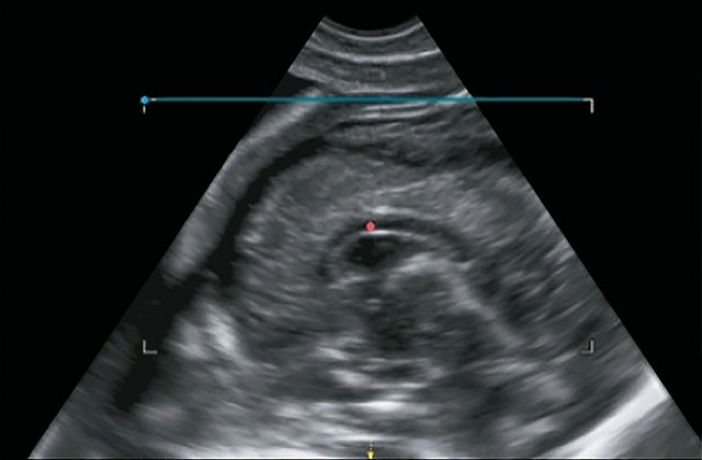 Эхограмма - изображение мозга плода в сагиттальной плоскости (b)