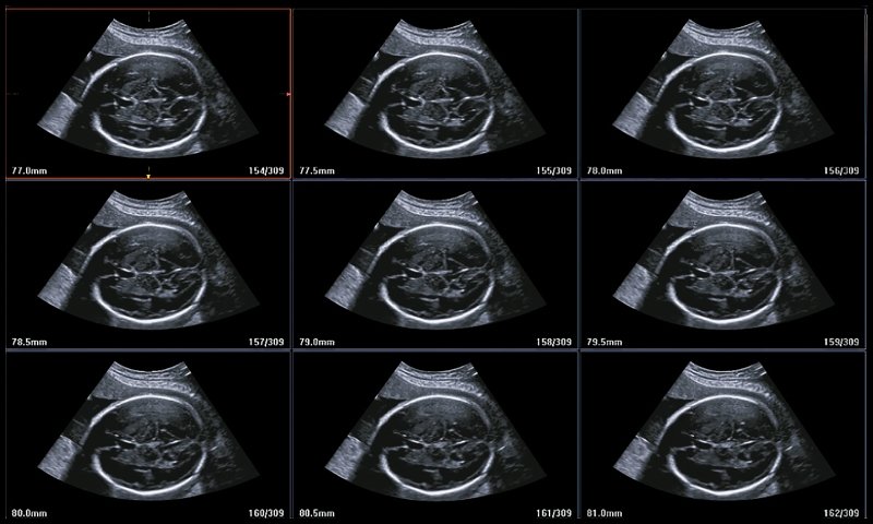Эхограмма - режим MultiSlice View, параллельные срезы объемного изображения головки плода