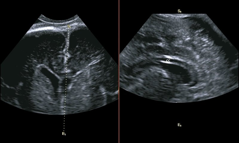 Эхограмма - режим Oblique View, слева изображен фронтальный срез объемного изображения, справа - мозолистое тело