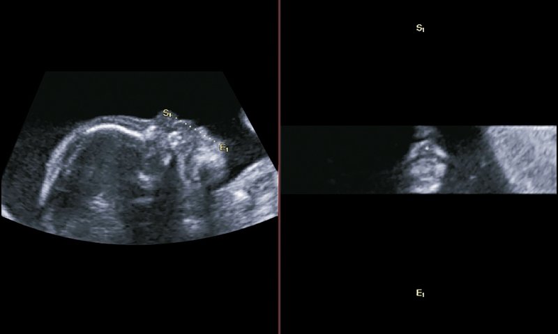 Эхограмма - режим Oblique View, слева изображен сагиттальный срез изображения лица плода, справа - губы