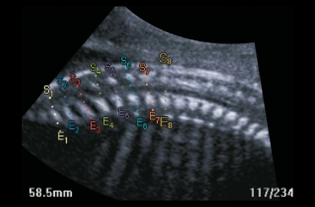 Эхограмма - режим Multi OV, в аксиальных проекциях объемного изображения, полученного в сагиттальной проекции, представлены различные аксиальные срезы позвоночника