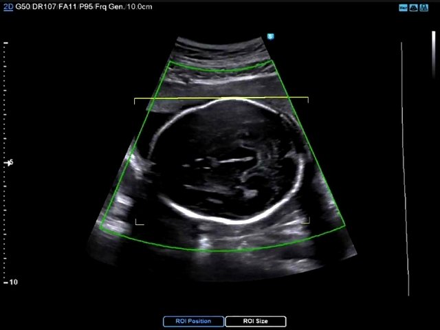 Эхограмма - аксиальное сечение изображения головного мозга плода, где область интереса (ROI) при 3D-сканировании охватывает всю окружность головки