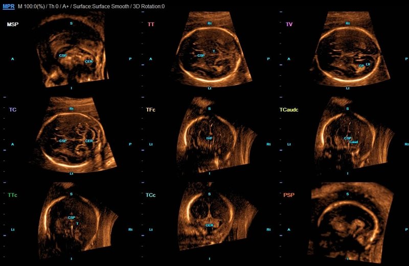 Пример первого результата, выданного приложением 5D CNS+, с отображением всех диагностически значимых плоскостей