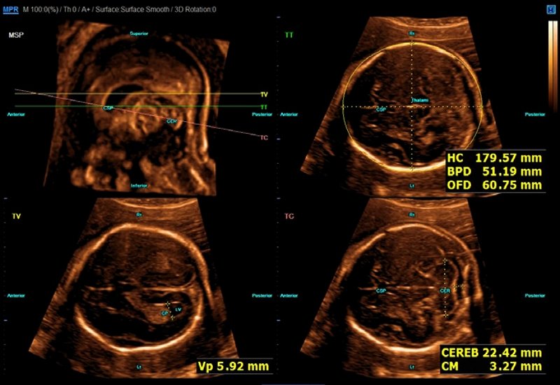 Эхограмма - изображение аксиальных плоскостей головного мозга плода
