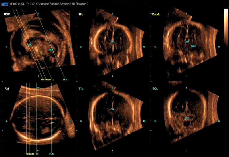 Эхограмма - изображение фронтальных плоскостей головного мозга плода