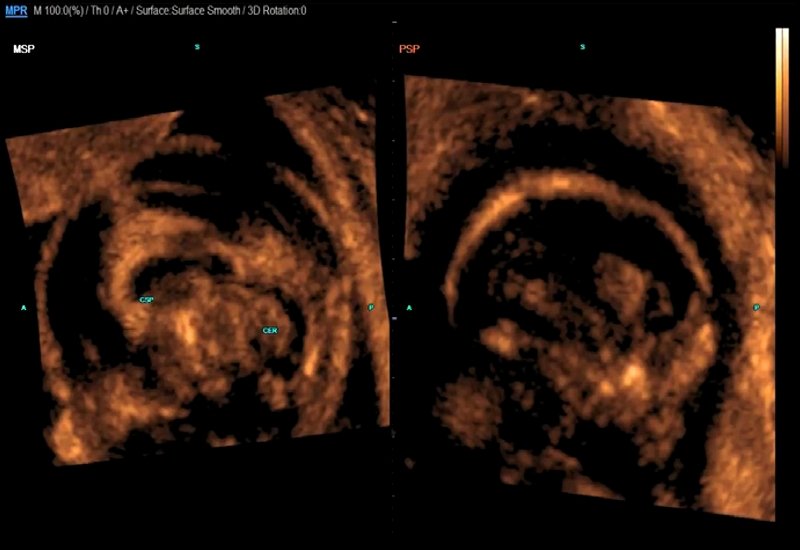 Эхограмма - изображение сагиттальных плоскостей головного мозга плода
