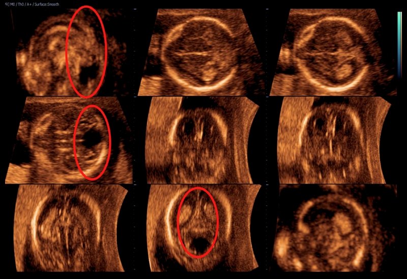 Эхограмма - гипоплазия червя мозжечка, красными кругами указан небольшой червь на изображениях в срединной сагиттальной, трансцеребеллярной аксиальной и трансцеребеллярной фронтальной плоскостях