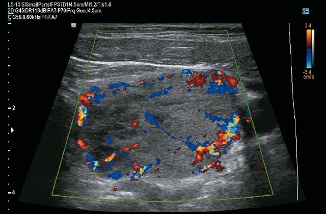 Эхограмма - узел щитовидной железы, режим цветового допплеровского картирования (b)