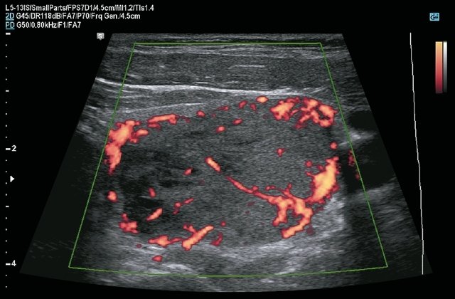 Эхограмма - узел щитовидной железы, режим энергетического допплера (c)