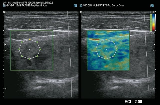 Эхограмма - узел щитовидной железы, режим E-Thyroid (d)