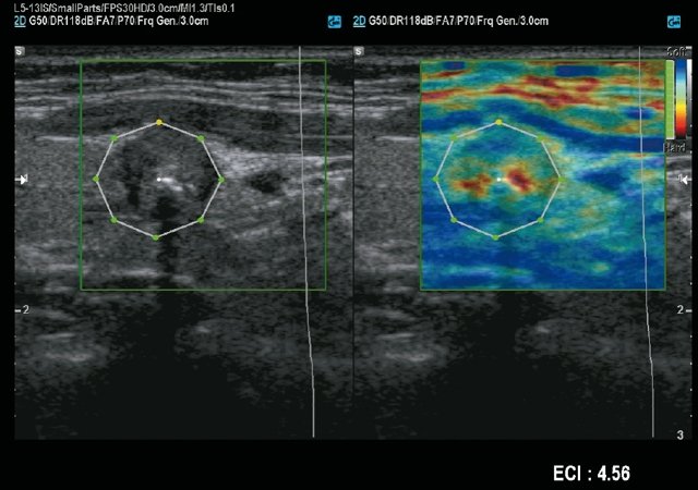 Эхограмма - узел щитовидной железы, режим режим E-Thyroid (c)