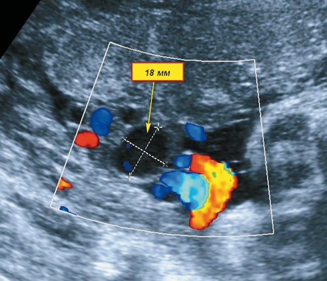 Аневризмы вены пуповины (поперечное сканирование)