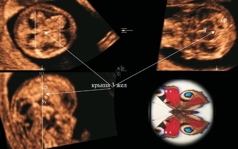 Ультразвуковая трехмерная реконструкция головного мозга плода в 12 нед + 2 дня