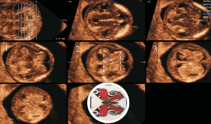 Ультразвуковая картина трех стандартных аксиальных срезов головного мозга плода в 12 нед + 2 дня