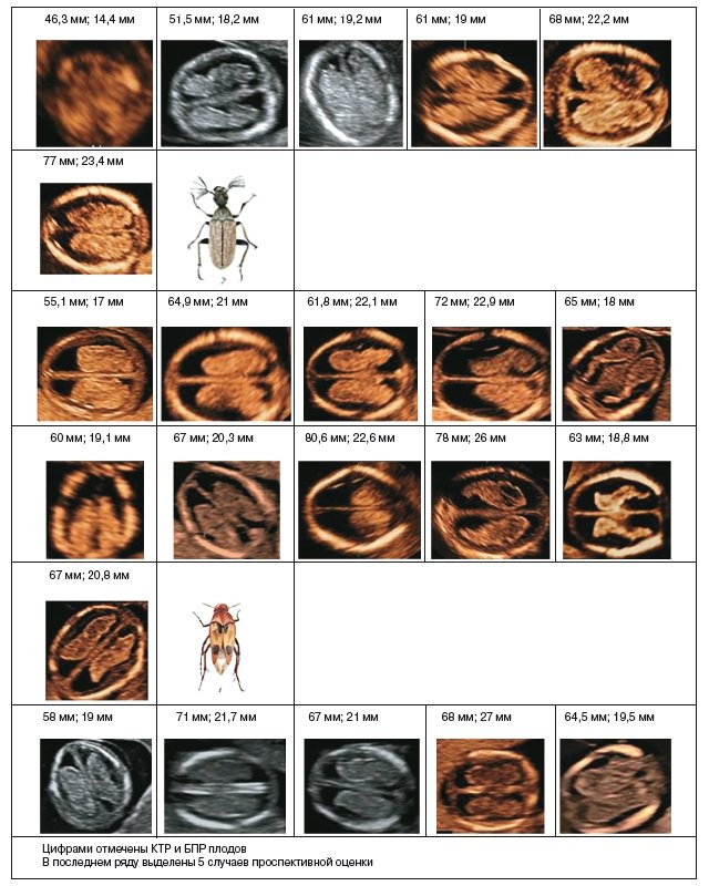 Эхографическая картина аксиального среза сосудистых сплетений на уровне крыши III желудочка у всех плодов с ОДП и сравнение с хитиновыми оболочками «тараканов»