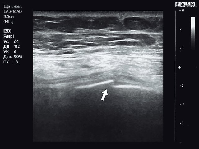 Эхограмма - косой перелом VII ребра левой половины грудной клетки (указан стрелкой)