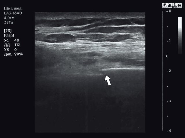 Эхограмма - косой перелом ребра левой половины грудной клетки (указан стрелкой)