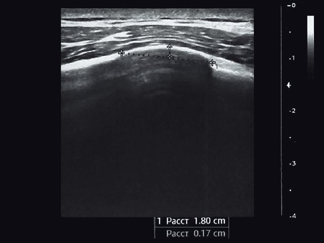 Эхограмма - костная мозоль через 24 мес после перелома, продольная проекция