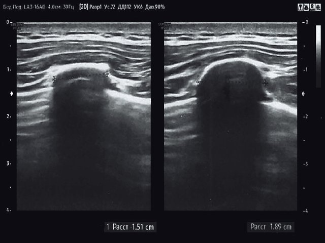 Эхограмма - костная мозоль через 24 мес после перелома, поперечная проекция