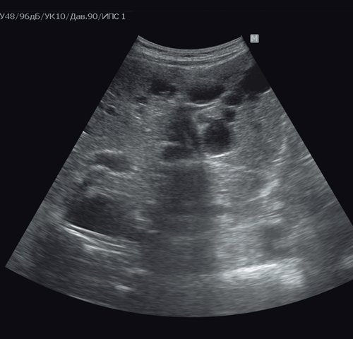Эхограмма поликистоза печени - в обеих долях печени визуализируются мелкие множественные жидкостные образования различного диаметра