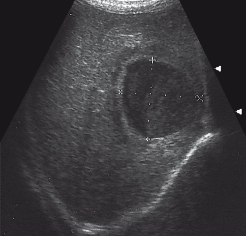 Эхограмма абсцессов печени - в печени определяется жидкостное образование с плотной капсулой, неоднородным содержимым в виде гиперэхогенной взвеси